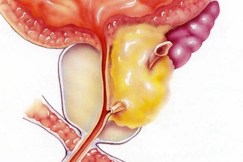 Entzündung der Prostata
